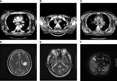 High-grade fetal adenocarcinoma of the lung misdiagnosed as male breast carcinoma: a case report and literature review